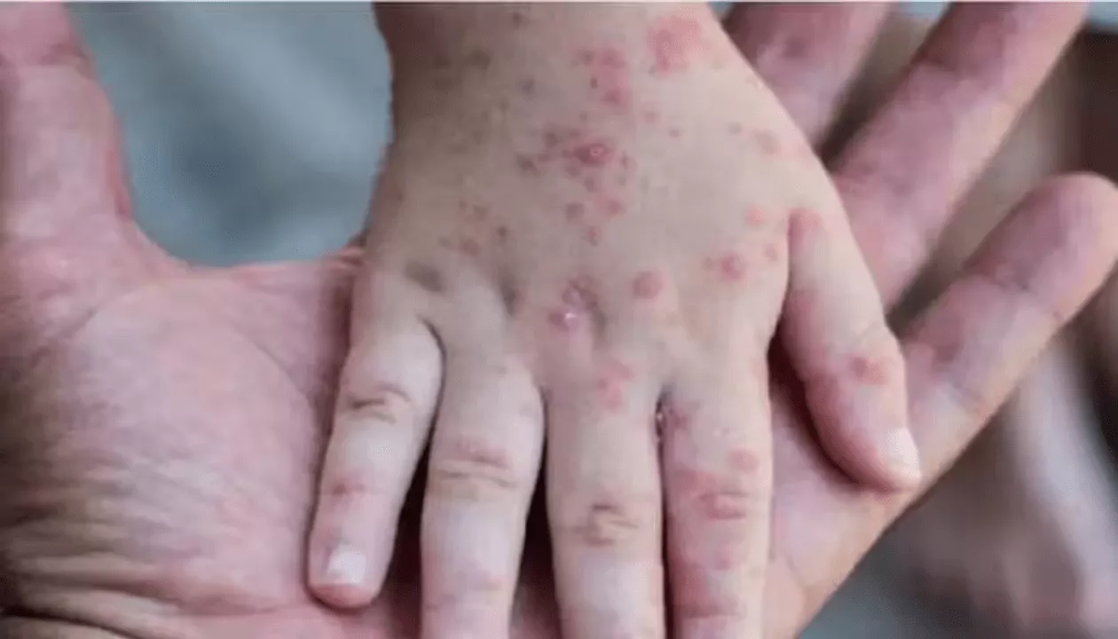 Maymun Çiçeği Virüsü (Mpox)